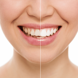 Lincoln Park Teeth Cleaning & Whitening twhitening 300x300